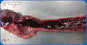 Clostridium perfringens